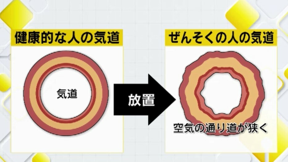 ぜんそくの人の気道は空気の通り道が狭い