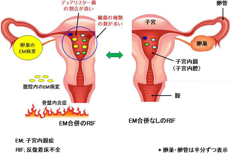 今回の研究の模式図。子宮内の細菌の遺伝子解析を行った（山梨大学提供）