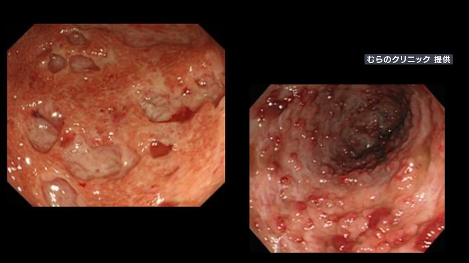 潰瘍性大腸炎患者の内視鏡写真（むらのクリニック提供）