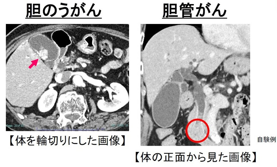 造影CTによる胆道がんの画像＝アストラゼネカ胆道がんメディアセミナー資料より