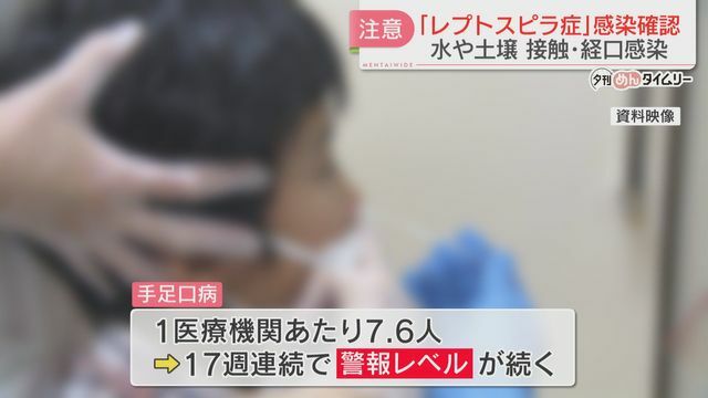 「手足口病」17週連続警報レベル