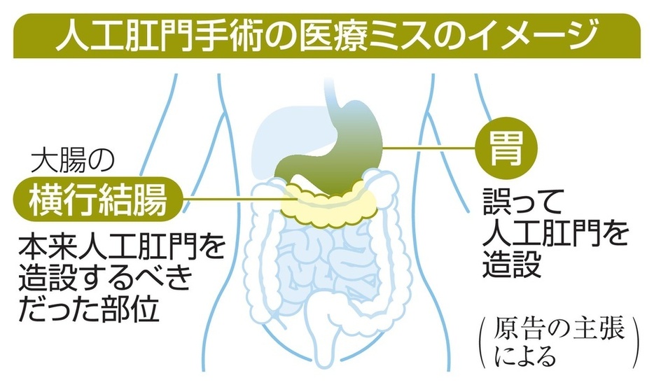 人工肛門手術の医療ミスのイメージ