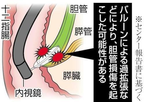 胆道鏡検査のイメージ図