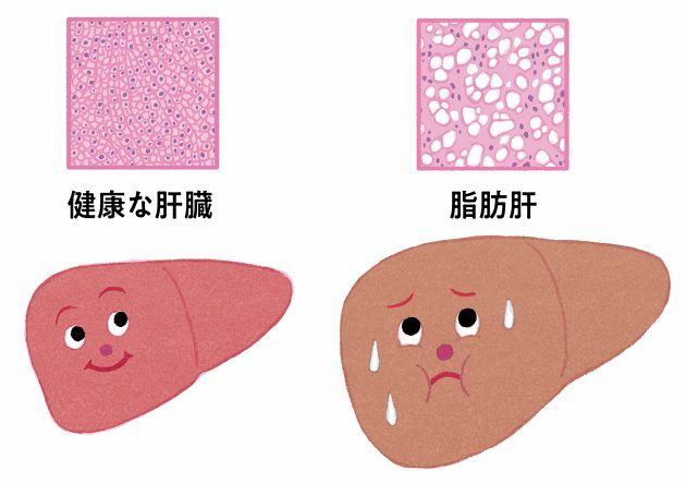 脂肪肝とは肝臓のまわりではなく、肝細胞の中に脂肪が溜まる病気。 脂肪が溜まった肝臓は自覚症状がないまま徐々に機能が失われていく。