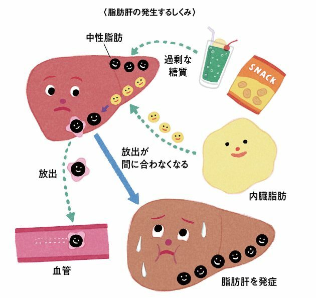 肝臓には他の内臓で余った脂肪が流れてくるほか、糖質が肝臓内で中性脂肪に変化する。血管に放出処理する能力を超えると脂肪肝の原因に。