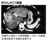 肝がんのCT画像