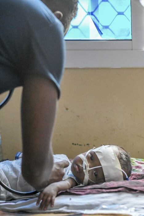 バナディル病院で、酸素吸入のためチューブを鼻につけた子ども＝５月１５日、ソマリア・モガディシオ（中野智明氏撮影・共同）