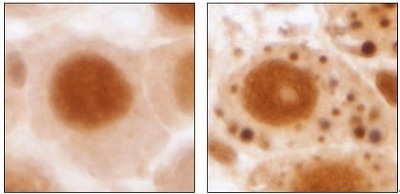 [写真]マウスの神経細胞。左の正常なマウスの細胞に比べ、右のオートファジーができないマウスの細胞では、タンパク質のかたまりがたまっている
