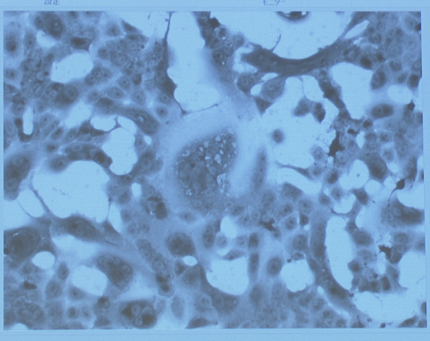 新型コロナウイルスに感染した細胞の写真。中心部の楕円状の箇所は、感染した細胞が融合してできた多核巨細胞