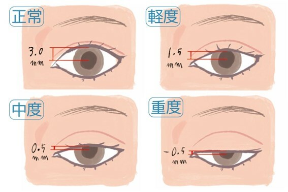 MRDによる眼瞼下垂の判定