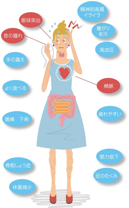 バセドウ病のおもな症状