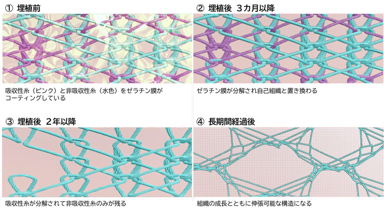 パッチが生体になじむ様子を図版にしたもの。あやとりのように美しい形で、吸収性糸と非吸収性糸がうまく絡み合ってできている（帝人提供）