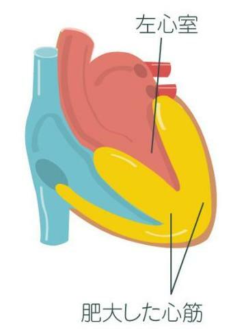 心筋が分厚くなった心臓
