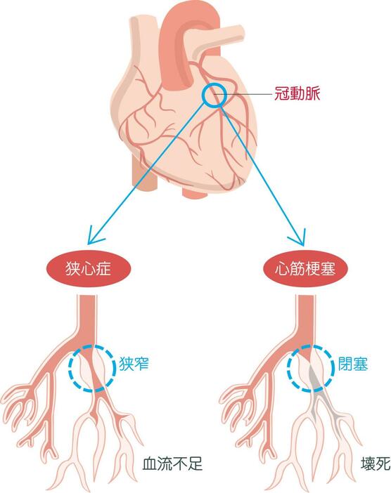 狭心症や心筋梗塞