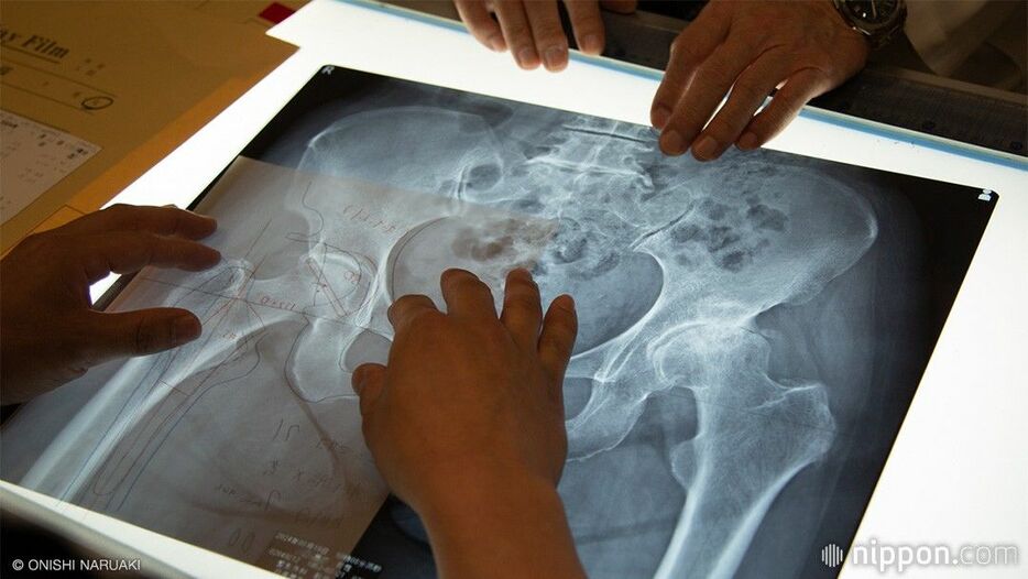 股関節のレントゲン写真を見ながら術式を検討