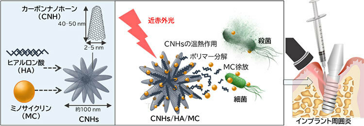光応答性ナノ複合体にヒアルロン酸とミノサイクリンを組み合わせ、インプラント周囲炎の部分に注入するイメージ図。歯ぐきの上から光を照射して殺菌する（北海道大学提供）
