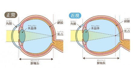 近視の仕組み