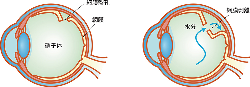 網膜の孔が開いた状態（左）と網膜剥離