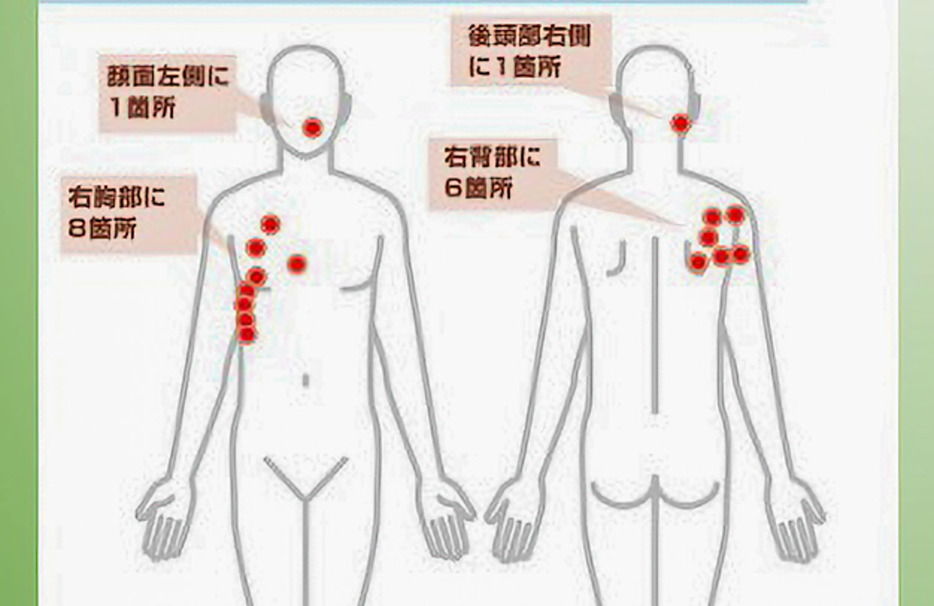 遺体の傷の位置