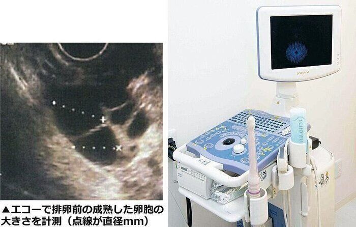 「最近は、治療方法についての情報などがあちこちにあふれているので、患者さんもみなさん勉強熱心」と田口先生。先生のところでは、卵胞の大きさを調べるエコー検査の結果を患者さんに提供しています。