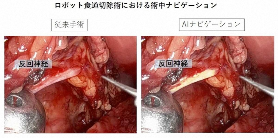 AIによってリアルタイムで神経など傷つけてはいけない構造の場所を認識することが可能となり、手術の安全性が高まるような技術が開発されています