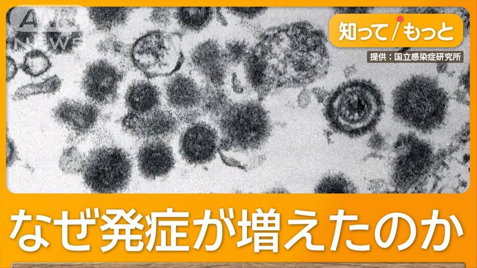 帯状疱疹のワクチン定期接種へ　50代から急増　激しい痛み「顔面神経まひ」「失明」も